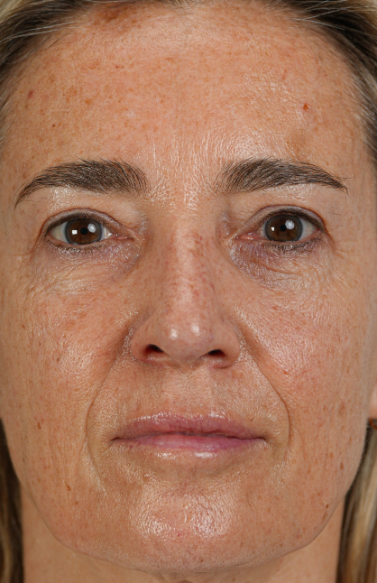 Image d’avant/après