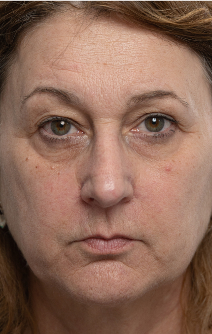 Image d’avant/après